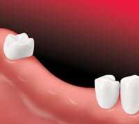Tooth replacement 1 Implants Dental Bridge