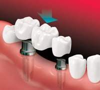 Tooth implant Insert implant