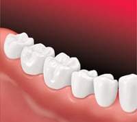 Implanted teeth replacement Dental implants