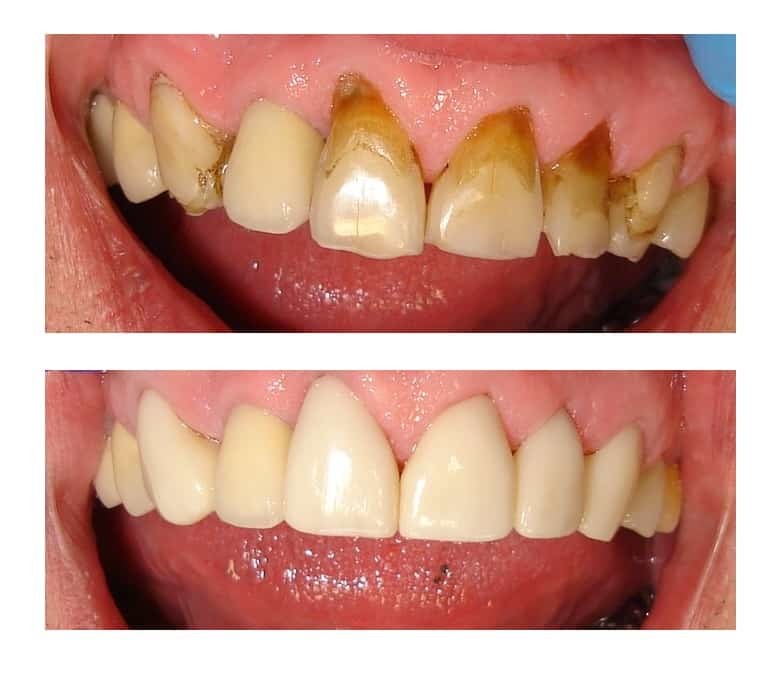 Cleaning up teeth