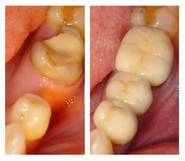 Before and after dental bridges