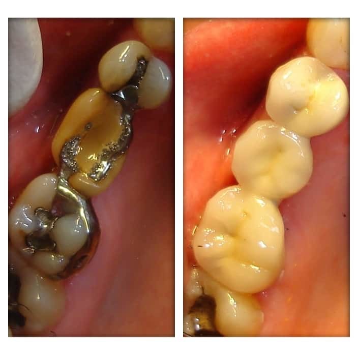 More dental bridges