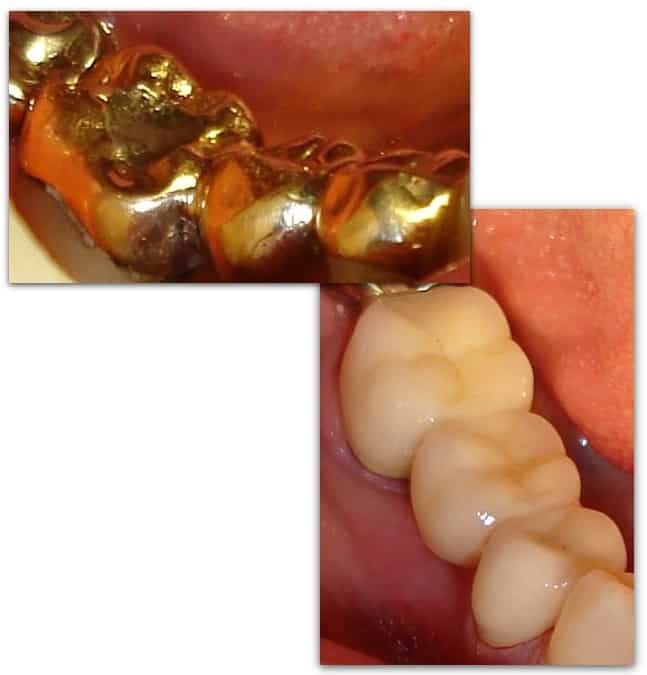 Lots of dental bridges