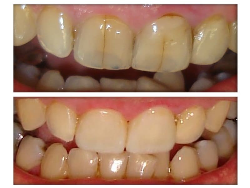 Cosmetic dentistry