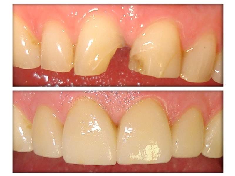 Cosmetic teeth