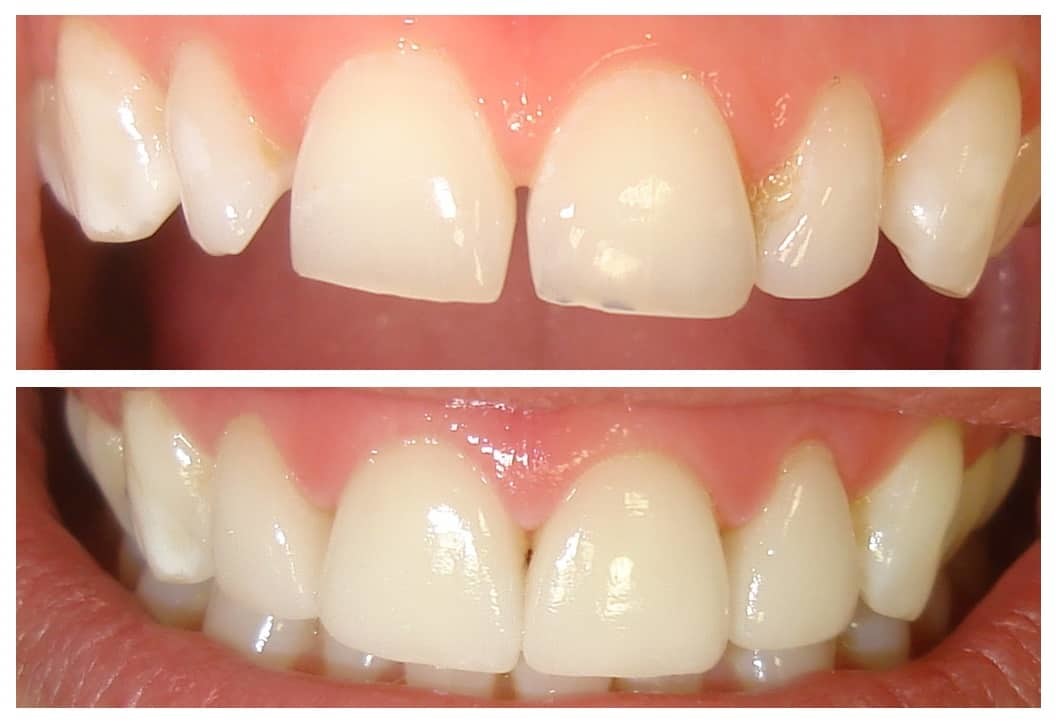 Before and after Simcoe dentist 2