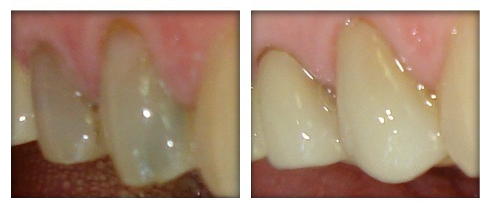 Before and after Simcoe dentist 4
