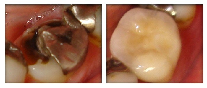 Dental Crowns 1
