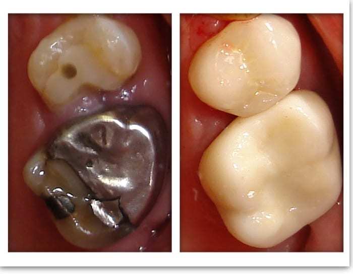 Dental Crowns 5