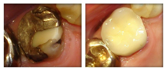 Dental Crowns 6