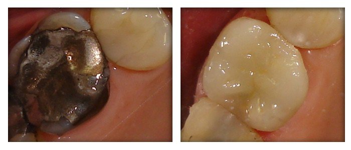 Dental Crowns 7
