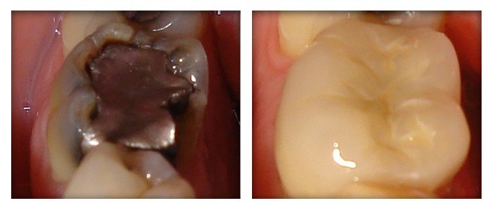 Dental Crowns 8