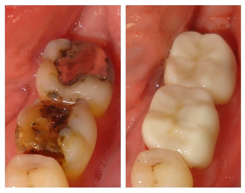 Dental Crowns Before and after