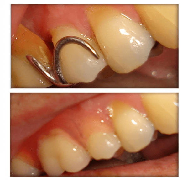 Dentures Simcoe Dentures Simcoe