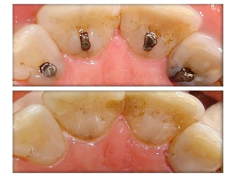 Fillings