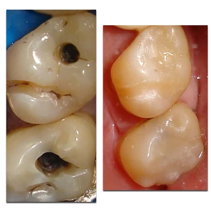 More fillings