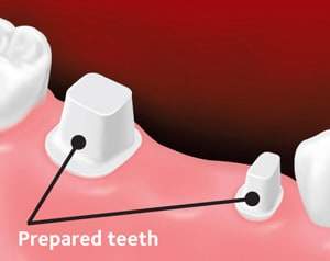fixedbridge2 Fixed dental bridge 1