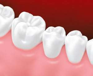 fixedbridge4 Fixed dental bridge 3