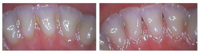 Dental Hygiene 1
