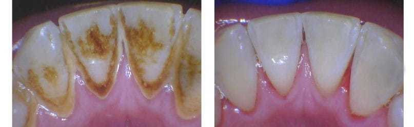 Dental Hygiene 2
