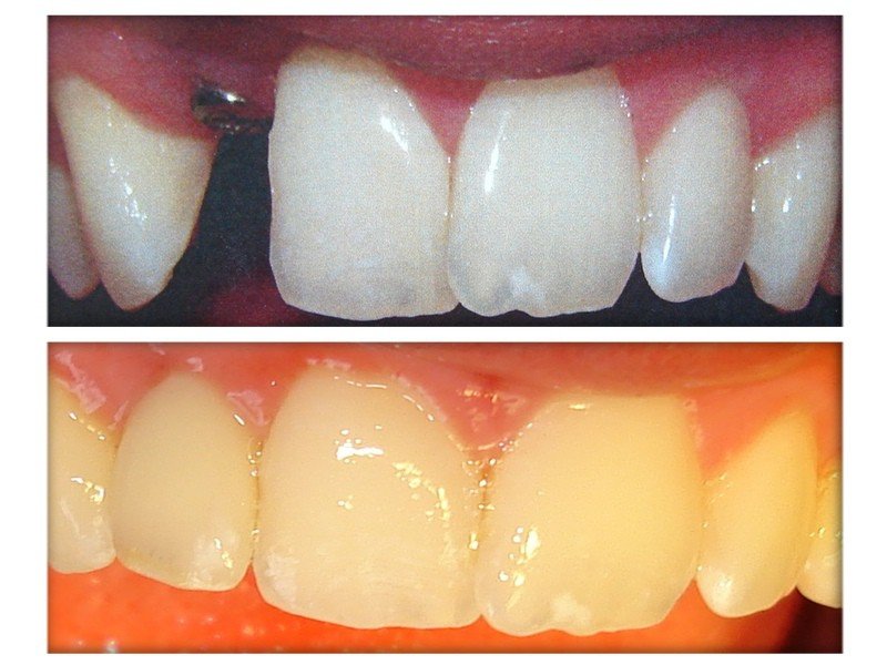 Dental Implants 1