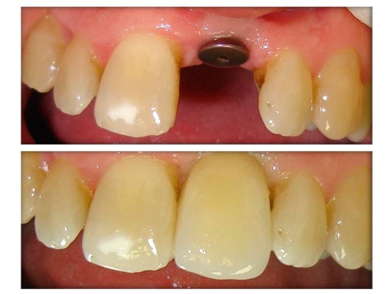 Dental Implants 2