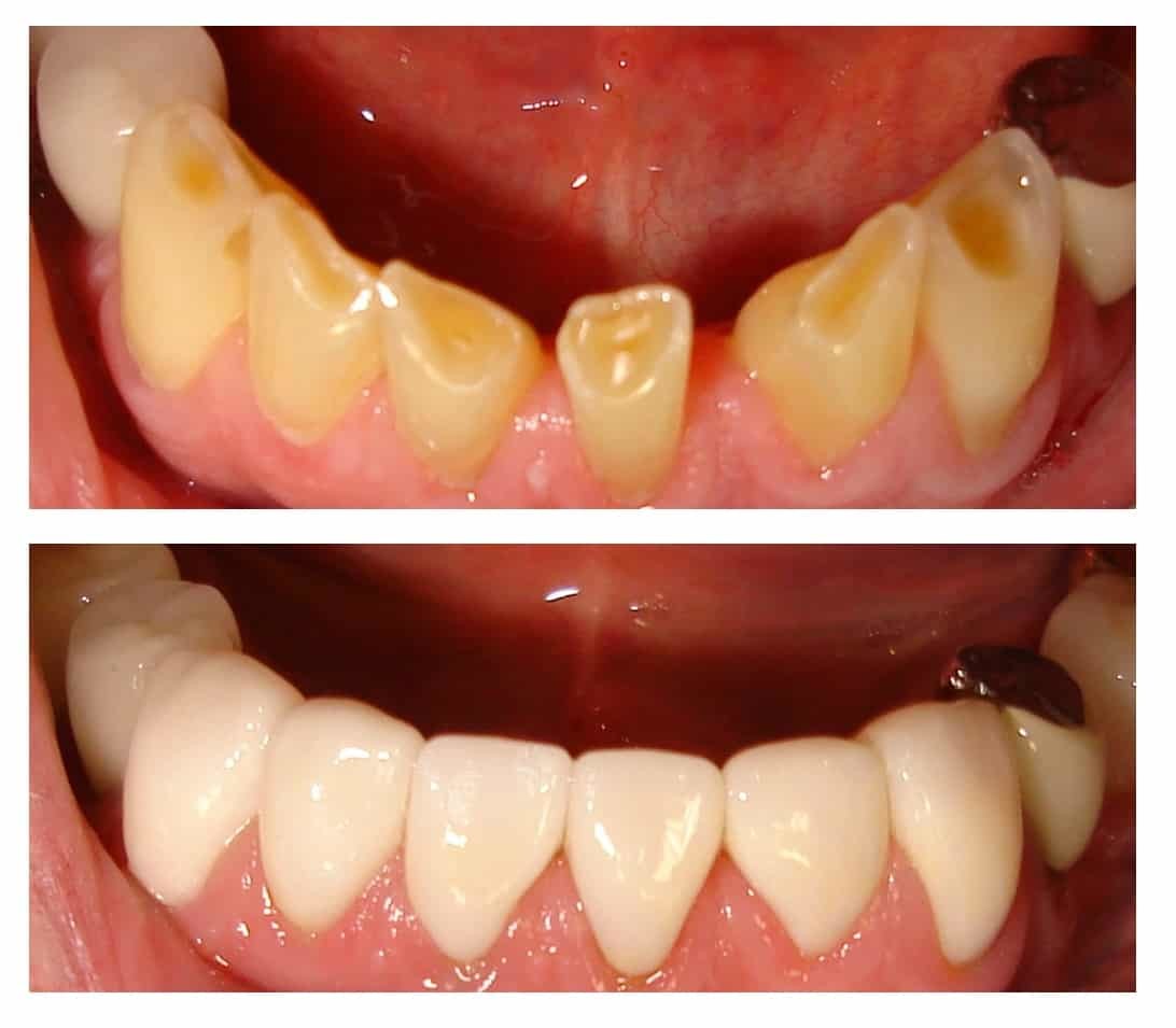 Cosmetic crowns