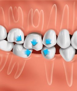 not-replaced Teeth Crowding