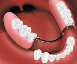 removable-partial-1 removable plate