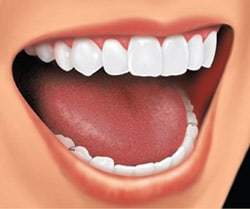 removable-partial-2 removable partial dental plate