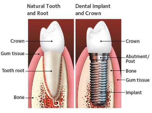 single-implant Single tooth implant